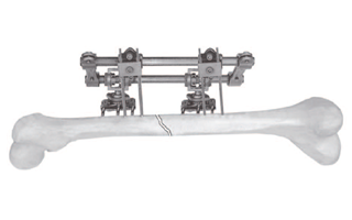 fixator2